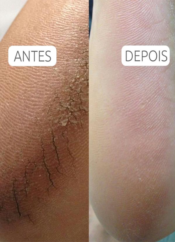 Lar e Lazer - Propodo Creme Hidradante para os Pés 70 G 3